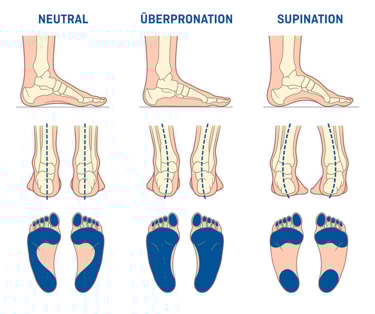 Darstellung von drei Fußstellungen: Neutral, Überpronation und Supination. Jede Haltung wird mit drei Ansichten gezeigt – Seitenansicht der Fußknochen, Rückansicht mit Ausrichtung von Sprunggelenk und Ferse sowie Fußabdruck zur Druckverteilung. Neutral zeigt eine ausgeglichene Ausrichtung, Überpronation eine Einwärtsdrehung mit Druck auf der Innenseite, Supination eine Auswärtsdrehung mit Druck auf der Außenseite